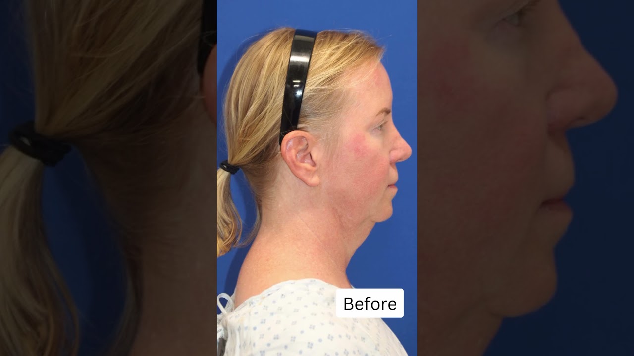 Her Neck Is GONE! Only 1 1/2 Weeks After Facelift!