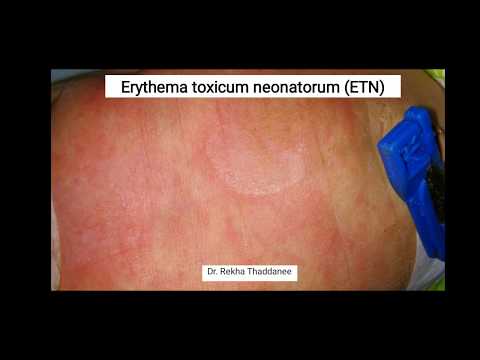 Erythema Toxicum Neonatorum | Pediatrics
