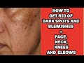 How To Clear Dark Spots on Face and Neck + Dark Under Eye Circles | Skincare Products Tips