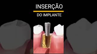 Implante Com Coroa Sob Implante