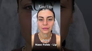 **Lip Contouring at Cici Beauty – Soft, Balanced Lip Filler in Hanoi** Natural lips never go out of