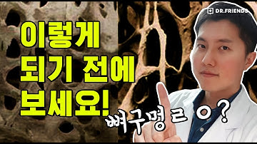 골다공증 예방과 치료 - 지금부터 시작해야 하는 이유