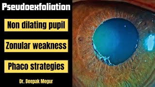 Phaco In A Eye With Rigid Non Dilating Pupil With Pseudoexfoliation And Loose Zonules B-Hex Ctr