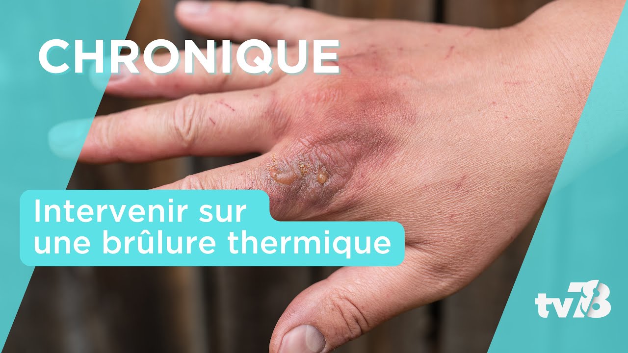 Le geste de la « Croix Blanche 78 » : La brûlure thermique