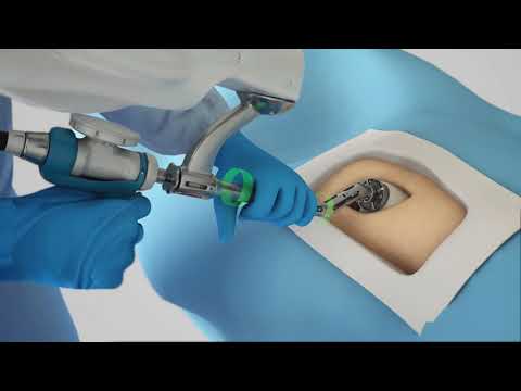 Ρομποτική Αρθροπλαστική Ισχίου MAKOⓇ