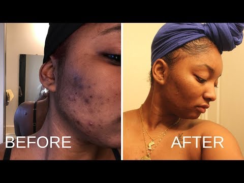 UPDATED SKINCARE ROUTINE! | GET RID OF DARK MARKS and ACNE SCARRING! | #AcneJourney #SkincareRoutine