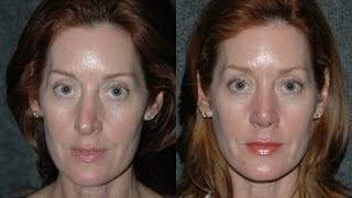 Revision Rhinoplasty Surgery for a Female Model by Dr Andrew Jacono #revisionrhinoplasty