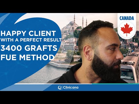 Nima’s hair transplant