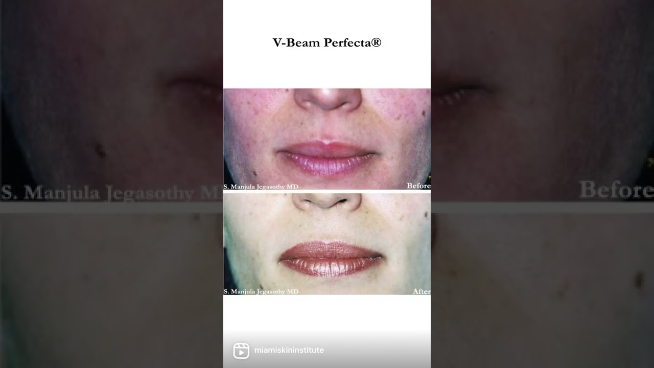 Miami Skin Institute's Cosmetic Laser Treatments!