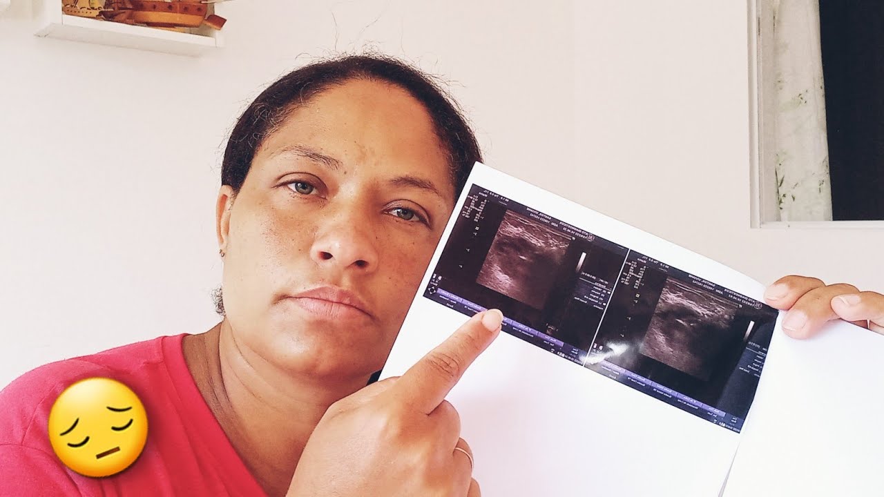 tenho-um-n-dulo-na-mama-e-o-diagn-stico-de-c-ncer-youtube