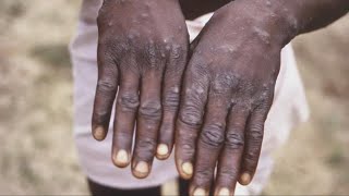 Possible Monkeypox case identified in Sacramento County | Top 10
