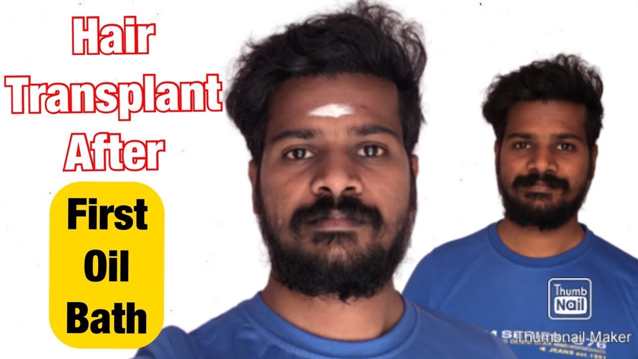 My Hair Transplant After First Oil Bath Tamil முடிமாற்று அருவை