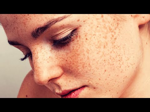Причины пигментации кожи | Почему происходит пигментация кожи
