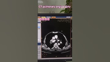 CT pulmonary angiography #youtubeshorts #shortvideos #viralvideos #ctscan #trendingshorts #short