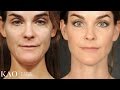 Massai Neck Lift: Katie's Transformation - KAO Plastic Surgery - Before and After