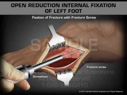 Reversal Of Internal Fixation Foot 99