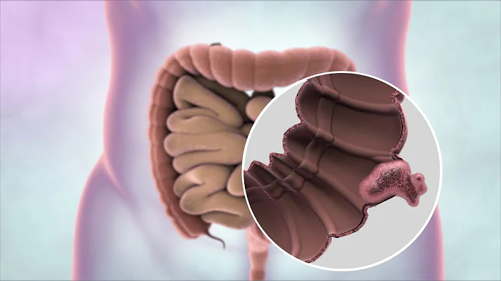 What is bowel cancer? | Cancer Research UK - DayDayNews