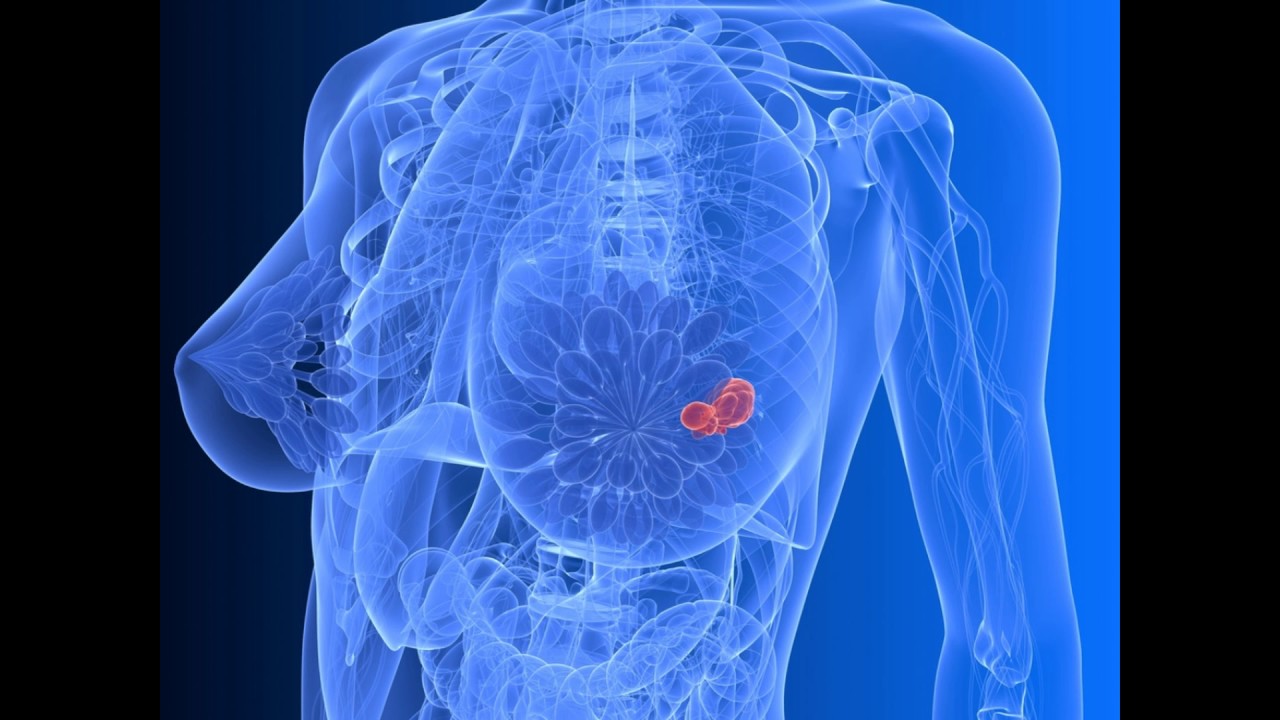 Мастопатия молочной железы симптомы - YouTube