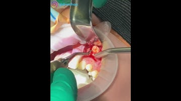 Impacted Canine Removal Maxilla How to Extract Bucally Impacted Canine Dental Crowding