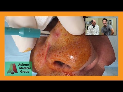 Nose Basal Cell Carcinoma Punch Biopsy | Auburn Medical Group