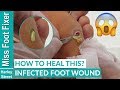 HOW TO TREAT INFECTED FOOT WOUND WITH PUS BY MISS FOOT FIXER MARION YAU