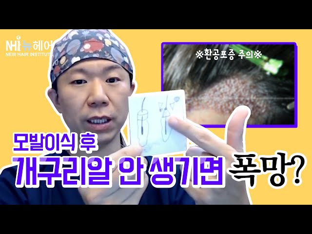 개구리알 도대체 뭐길래? 모발이식 이후에 생기는일? - 뉴헤어 I [모발이식][모발이식후기]