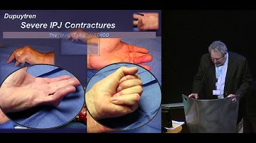 Dr. Clayton Peimer "PIP joint  Minimally invasive methods" 2015 Dupuytren Symposium