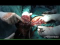 Caesarean section(LSCS)