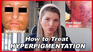 HYPERPIGMENTATION treatments  how to get rid of dark spots successfully (2021) HIGHLY EDUCATIONAL!