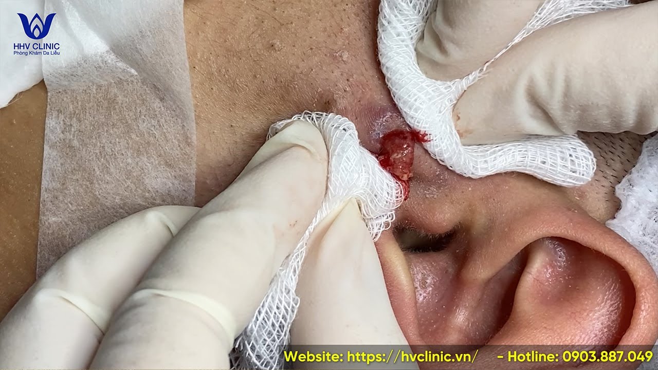 Nặn mụn ở cạnh tai phồng to và gây đau – nặn xong nhẹ hẳn.