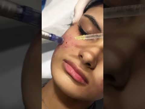 جلسة اكسوزوم لعلاج مشاكل البشرة مع د صباح النجم     