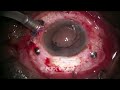 Large Intra Ocular Foreign Body