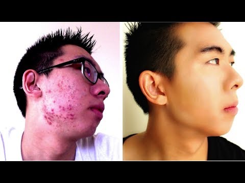 how to get rid of acne and acne scars for men