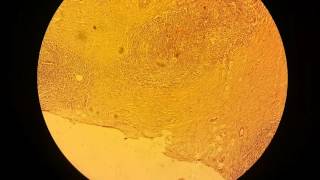 MOV 0108 - Nodular Sclerosis - Lymp node