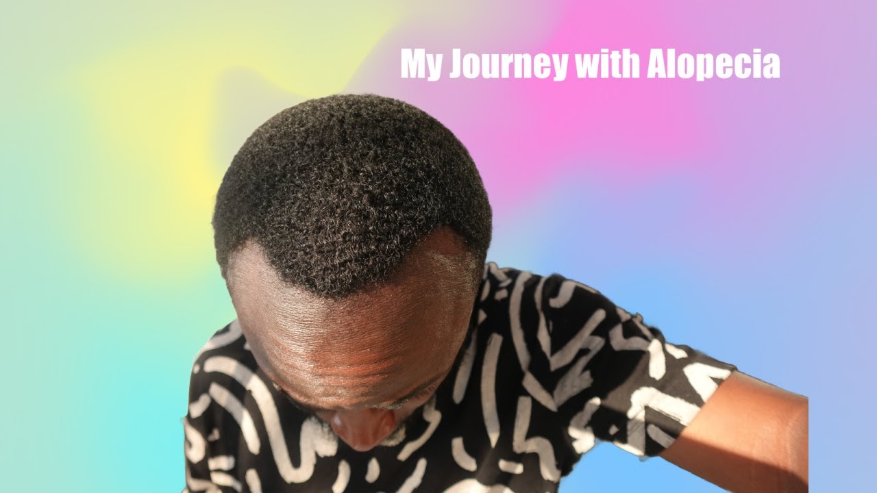 360 Waves | My Journey with Alopecia