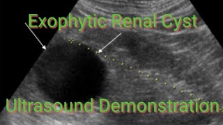 Exophytic Renal Cyst On Ultrasound Demonstration Video