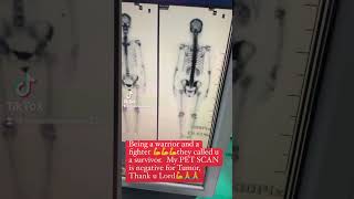 Breast Cancer Stage 2B And Endometrial Cancer Survivor