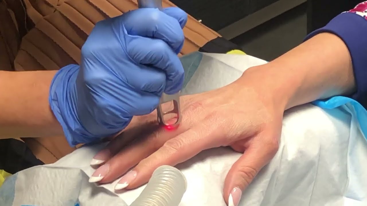 Reversing the Signs of Aging on the Hands with UltraClear!