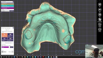 Exocad - Maxilla Immediate Load Conversion Prosthesis Design using Matera and Pontic Wax Ups