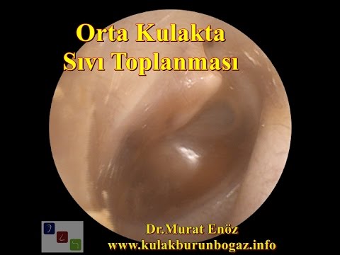 Orta Kulakta Sıvı Birikimi (Seröz / Efüzyonlu Otitis Media)