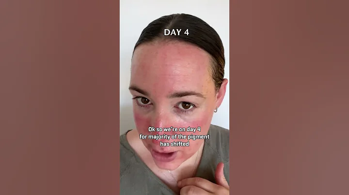 Fraxel Laser in Sydney | Daily Progress