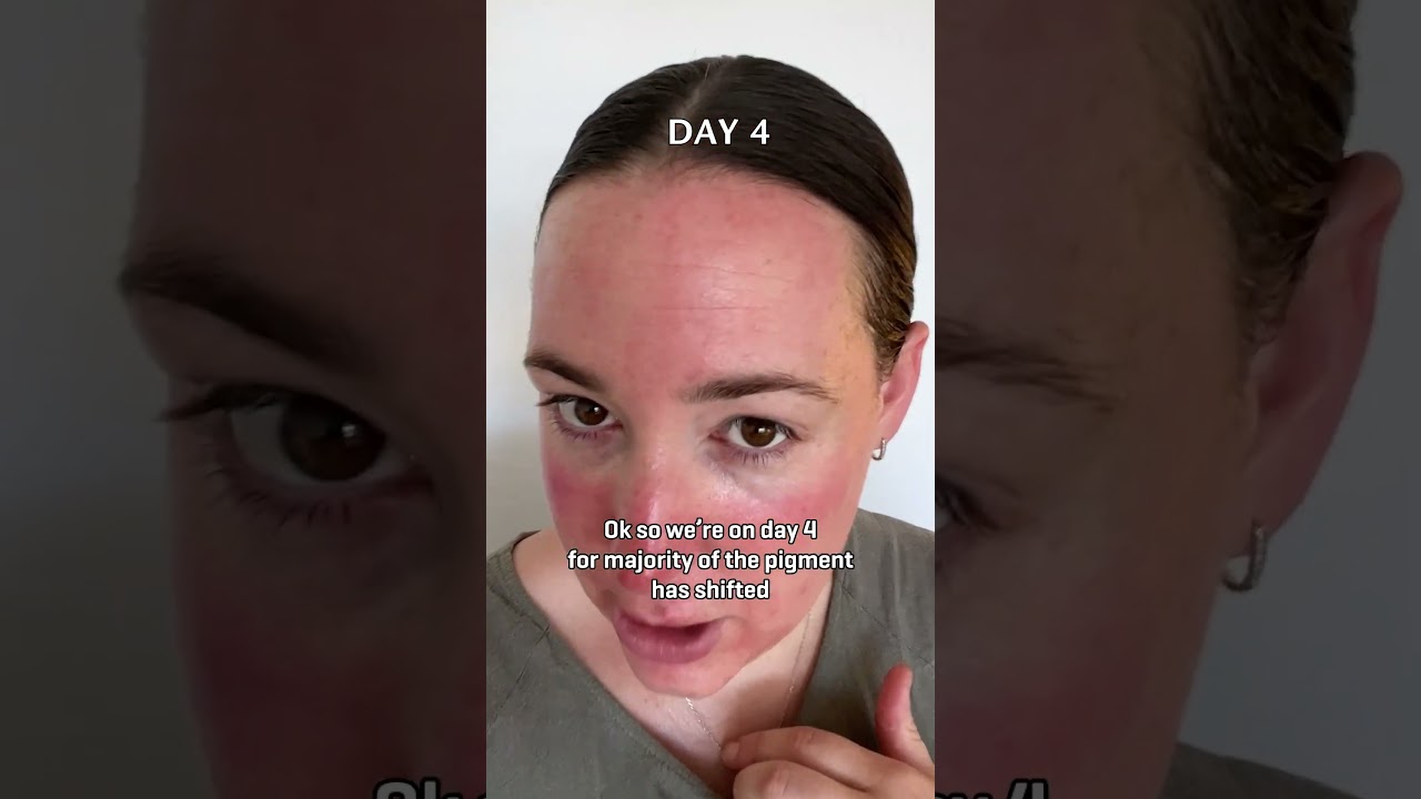 Fraxel Laser in Sydney | Daily Progress