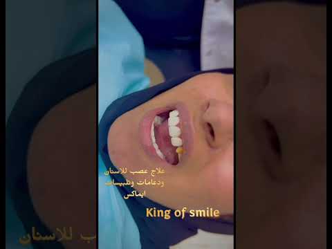 تلبيسات ايماكس دكتورمعتزالجزار