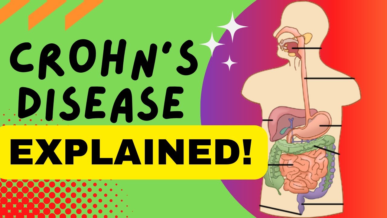 Crohn's Disease Overview, Causes, Risks, Symptoms, Diagnosis, Treatments & More YouTube