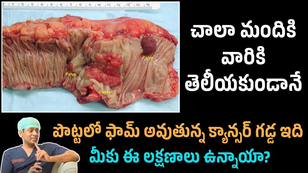 How to Avoid Colon Cancer | Reduces Constipation | Get Free Motion | Dr.Chinnababu Sunkavalli Tips