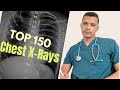 Top 150 Chest x-ray | Lecture 3 From zero to Hero