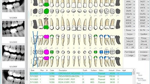 Eaglesoft - Patient Chart