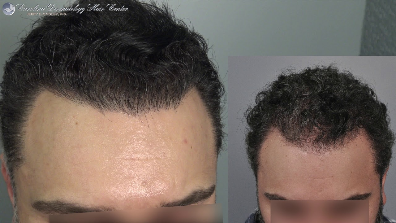 Witness Remarkable Hair Transplant Results: Before and After