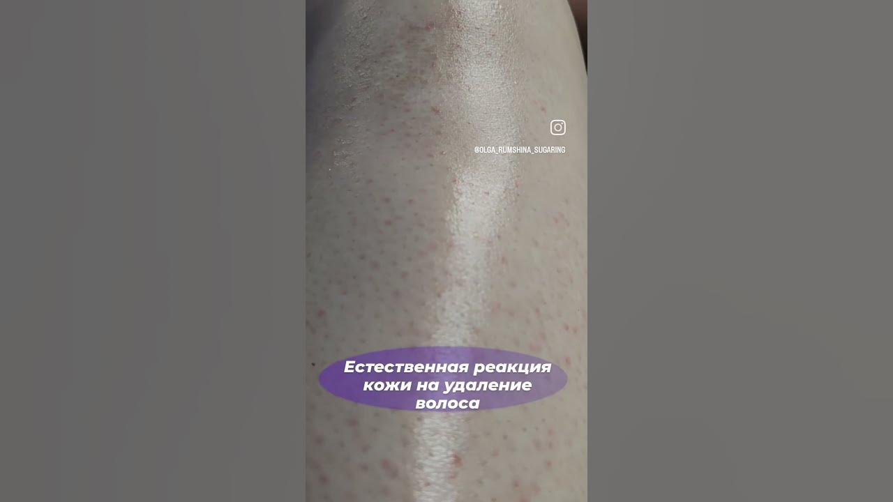 Депиляция ног и гистаминовая реакция. - YouTube