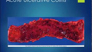 PTA 274 Chapter 17 Lecture Part 4 Lower GI Disorders